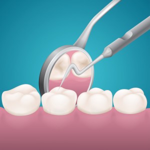 about cavities