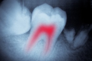 rootcanal