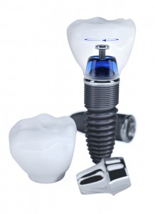 dental implants