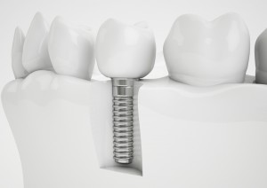 implant image