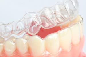 a look at invisalign clear braces