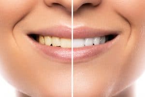 How to Choose Between Traditional Dental Braces or Invisalign