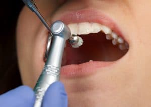 dental cleaning important