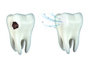 3 Things To Remember About Cavities