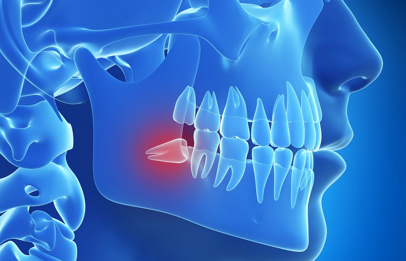 Are Wisdom Teeth Better