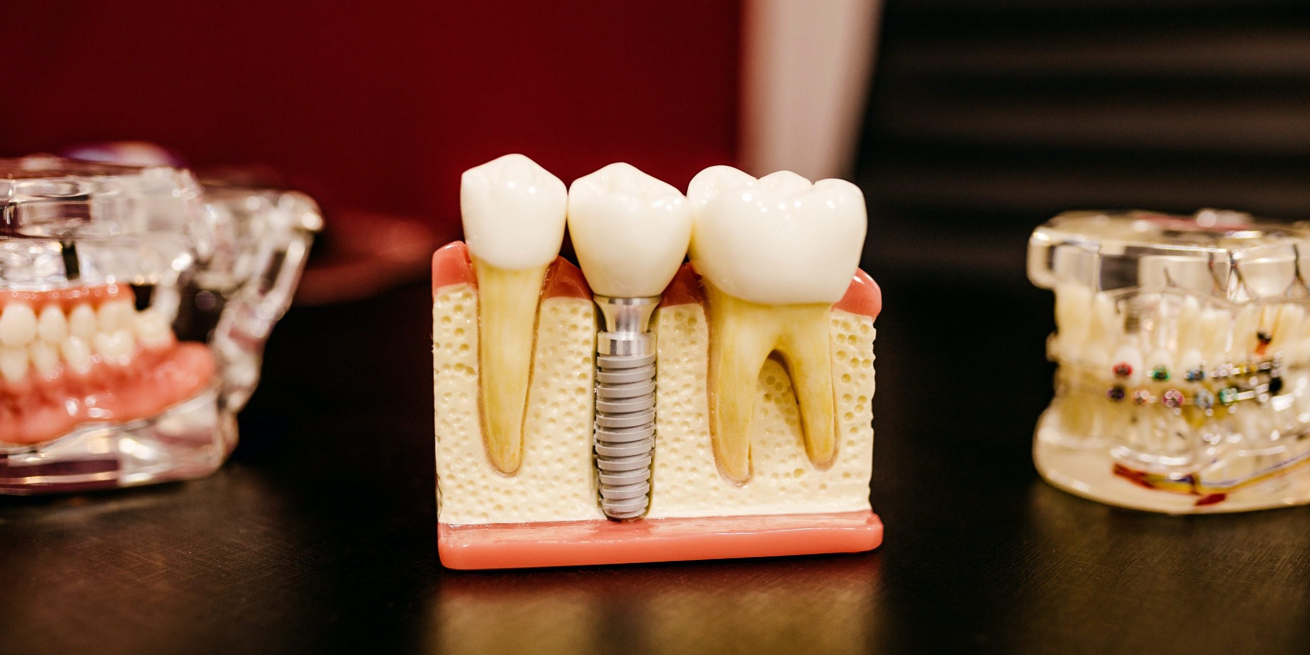 A cross-sectional model depicting how dental implants are inserted into the jaw bone to support a ceramic dental crown. A cross-sectional model depicting how dental implants are inserted into the jaw bone to support a ceramic dental crown.