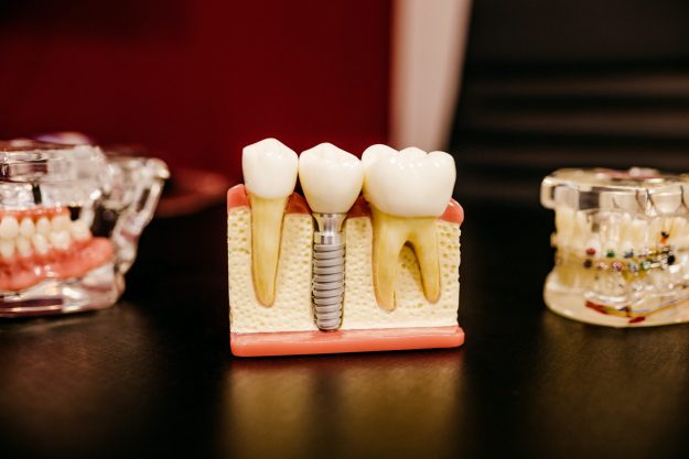 A cross-sectional model depicting how dental implants are inserted into the jaw bone to support a ceramic dental crown. A cross-sectional model depicting how dental implants are inserted into the jaw bone to support a ceramic dental crown.