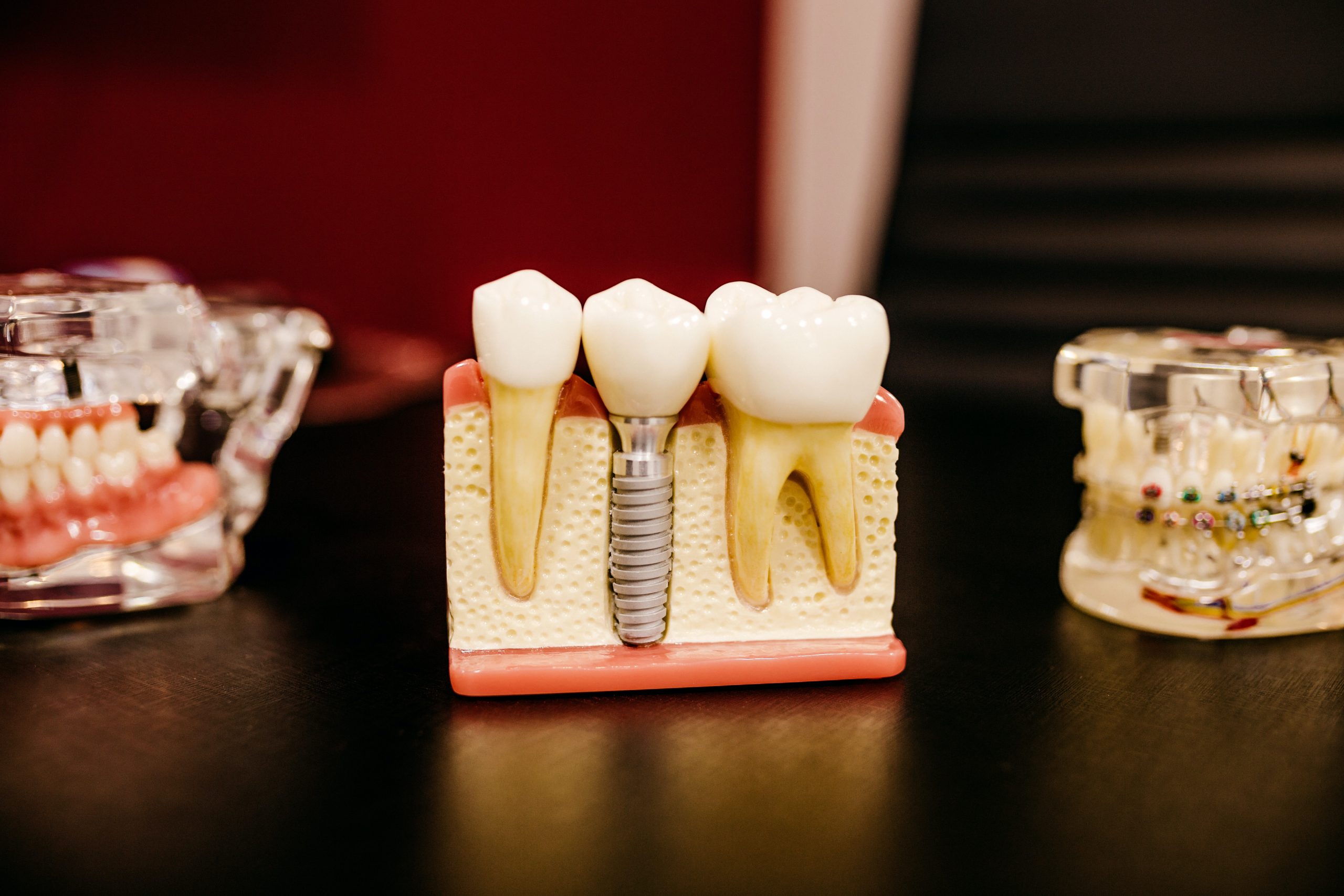 A cross-sectional model depicting how dental implants are inserted into the jaw bone to support a ceramic dental crown.