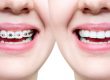 Side-by-side comparison of traditional dental braces and Invisalign