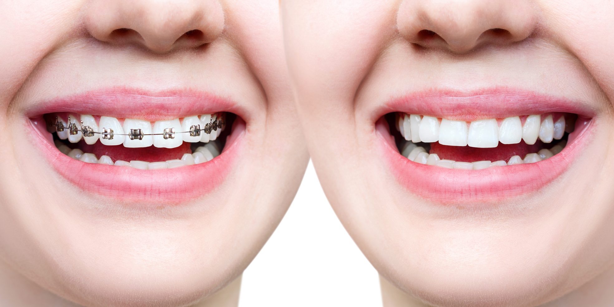 Myths About Traditional Metal Braces - Smiles Orthodontics