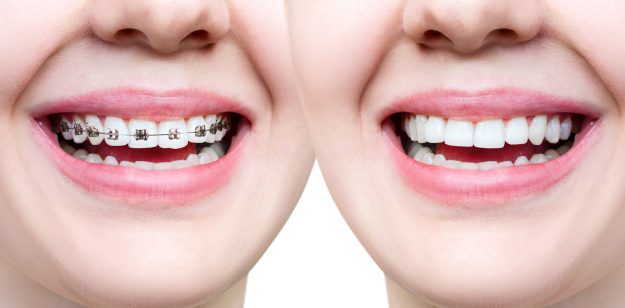 Side-by-side comparison of traditional dental braces and Invisalign