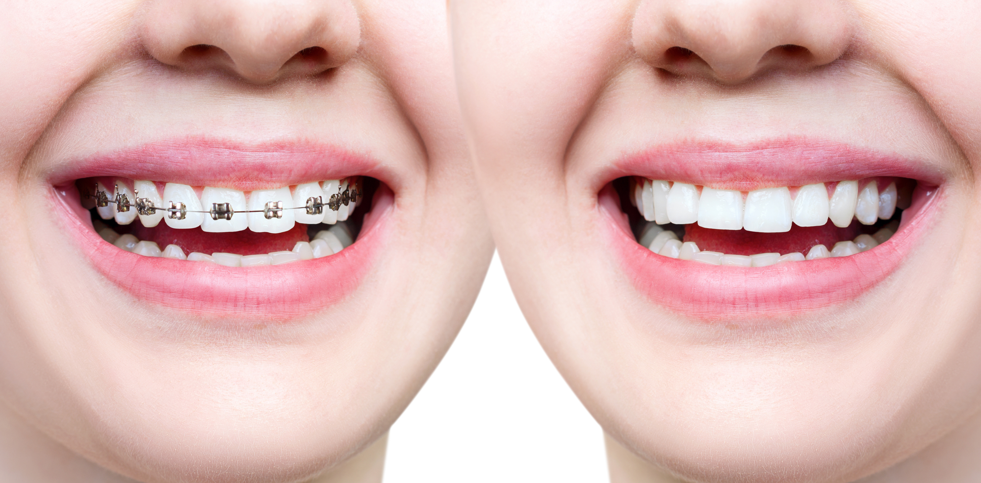 How To Choose Between Traditional Dental Braces Or Invisalign® 23 Smiles